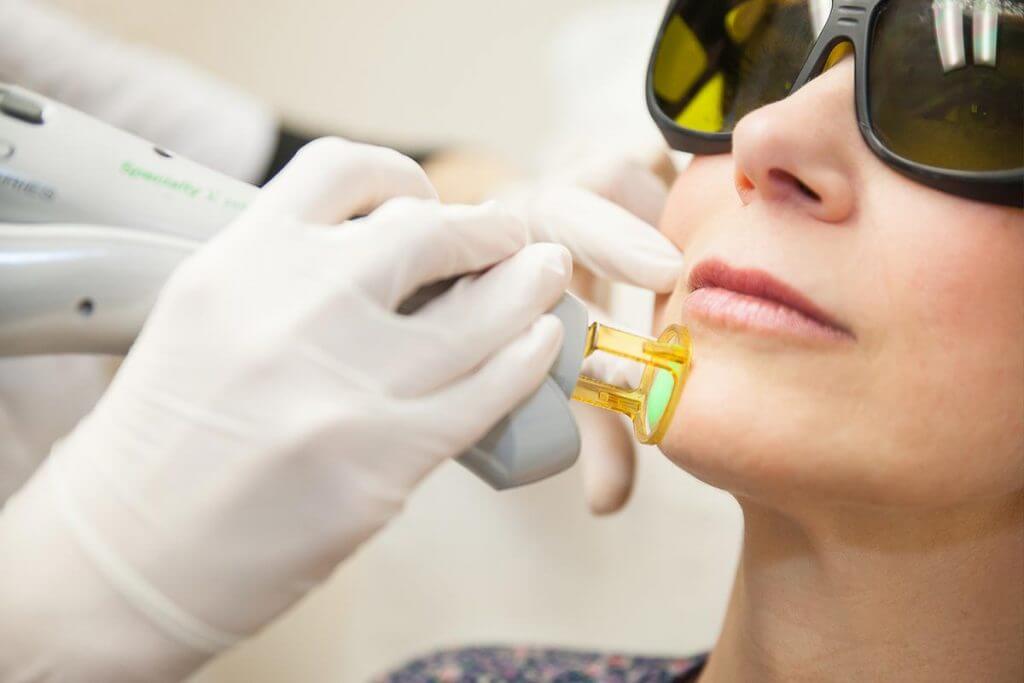 L’épilation laser femme au niveau du visage
